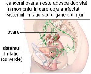 cancer ovarian